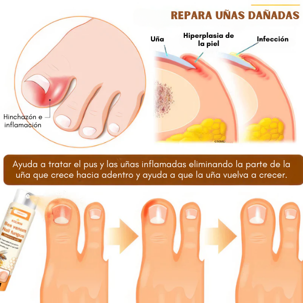 NailFungus™ - Spray para Eliminar Hongos Difíciles
