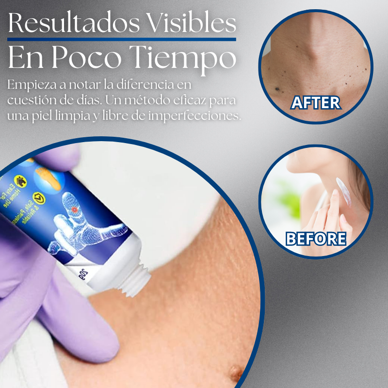 DermaErase™ ¡Piel Limpia SIN CIRUGÍAS ni Cicatrices!