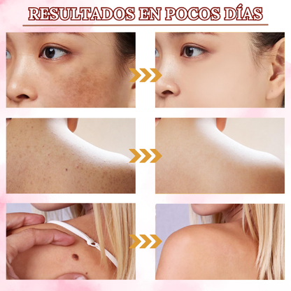 SkinClean™ - Eliminador Efectivo de Verrugas y Lunares